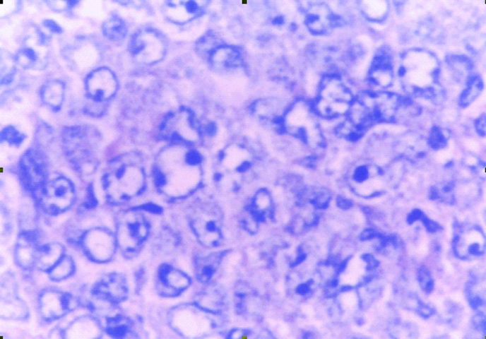 Fig. 4: Linfoma gstrico de tipo DLBCL. - <div style=